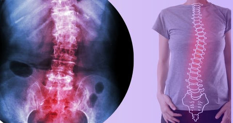 Mi vida con escoliosis y cómo TENS la cambió para siempre