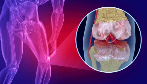 ¿Artrosis de rodilla? Alivia el dolor con ayuda de la TENS